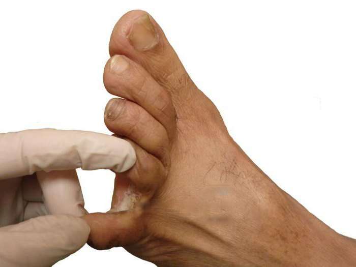 мозоль стержневая между пальцев ног  