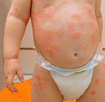 атопический дерматит у ребёнка симптомы