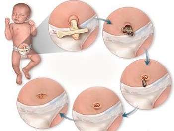 Схема: как обработать пупок новорожденному. Фото с сайта polonsil.ru