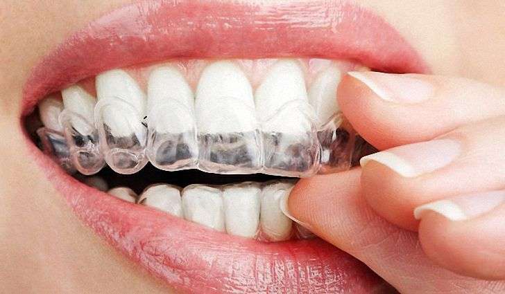 Капы для отбеливания зубов. В домашних условиях применение: достоинства и недостатки