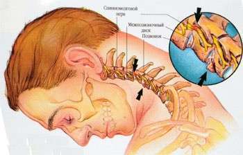 шейный остеохондроз шум в ушах лечение