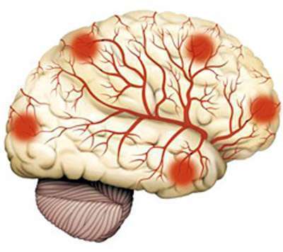 Диагностика атеросклероза сосудов головного мозга: лечение назначает врач!