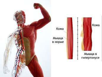 гипертония мышц это