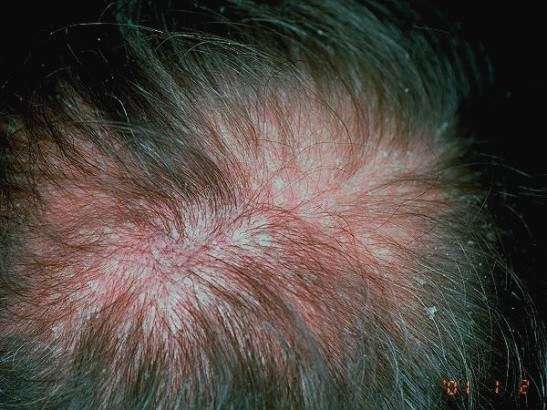  Псориаз волосистой части головы лечение 