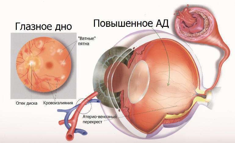 гипертония глаза 
