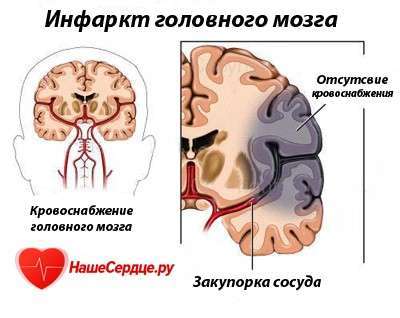 инфаркт головного мозга реабилитация