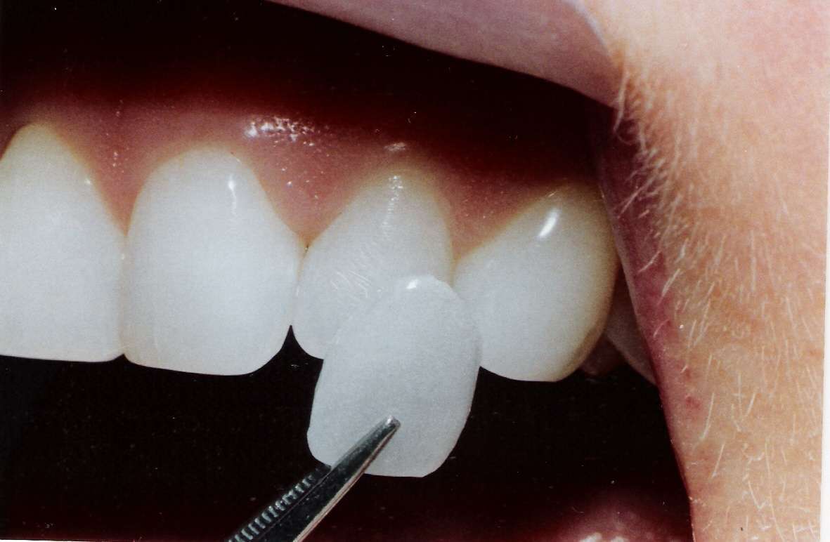 Как выправить зубы без брекетов?