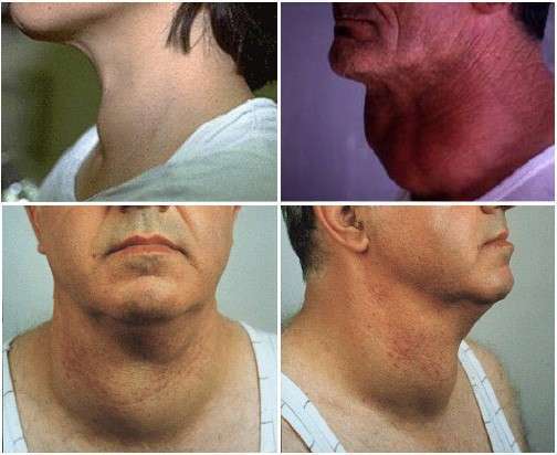 щитовидная железа болезни у мужчин