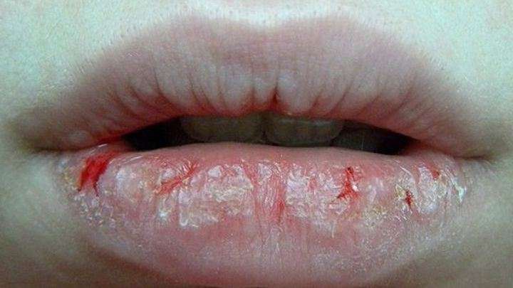 сухая кожа губ причины