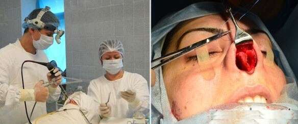 Сломан нос: как выпрямить и сколько стоит такая процедура?